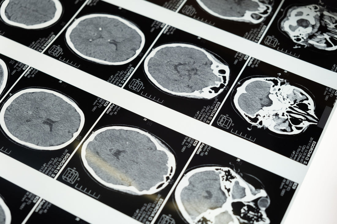 Coffee and Long-Term Brain Health: What the 2026 Research Actually Shows About Cognitive Decline